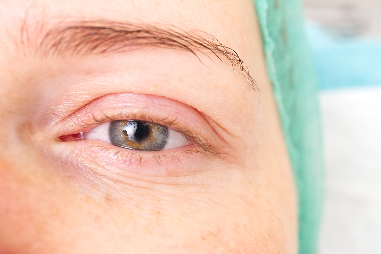 Close up image of a woman's eye to represent what occurs during the canthoplasty procedure.