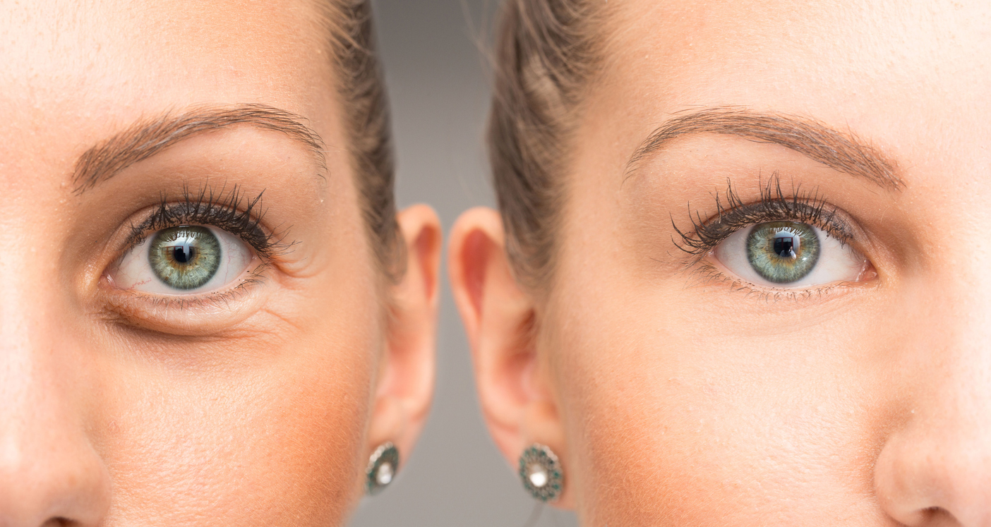 Featured image for How to Prepare for Cosmetic Eyelid Surgery