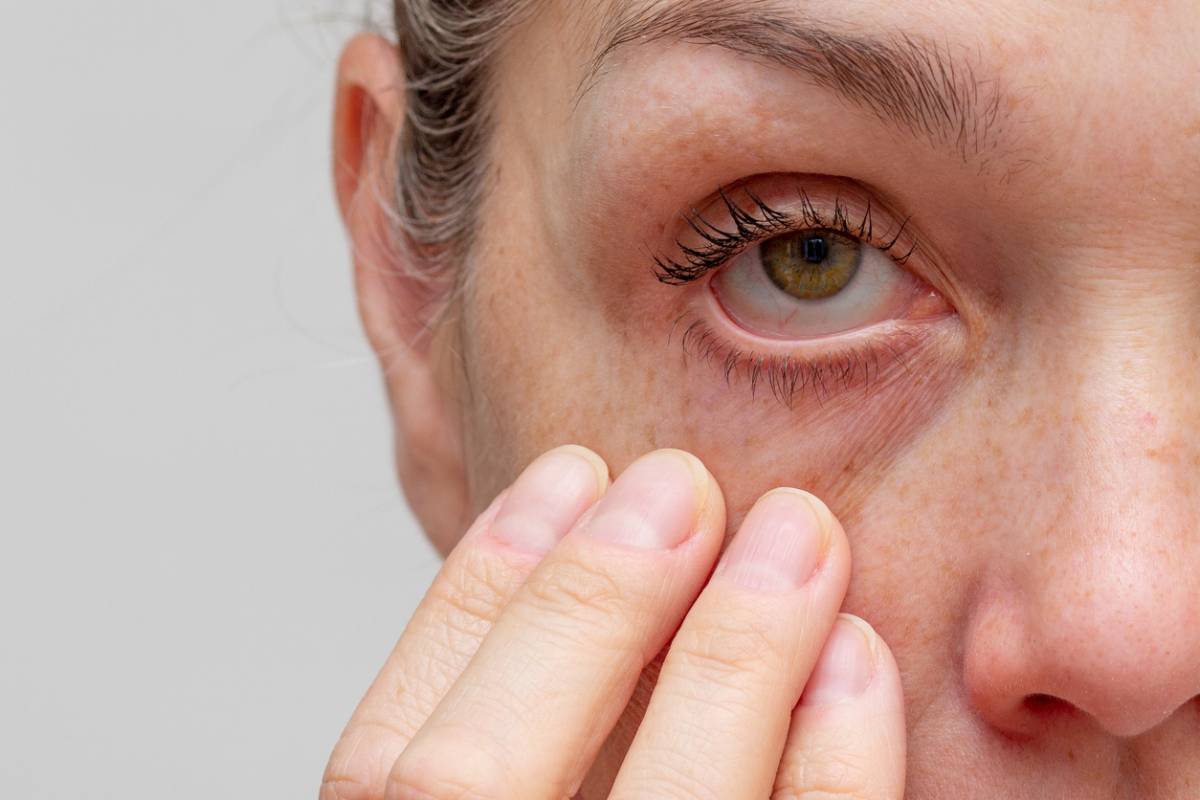 Featured image for Can You Get Blepharitis Surgery If You Have Fluctuating Ptosis